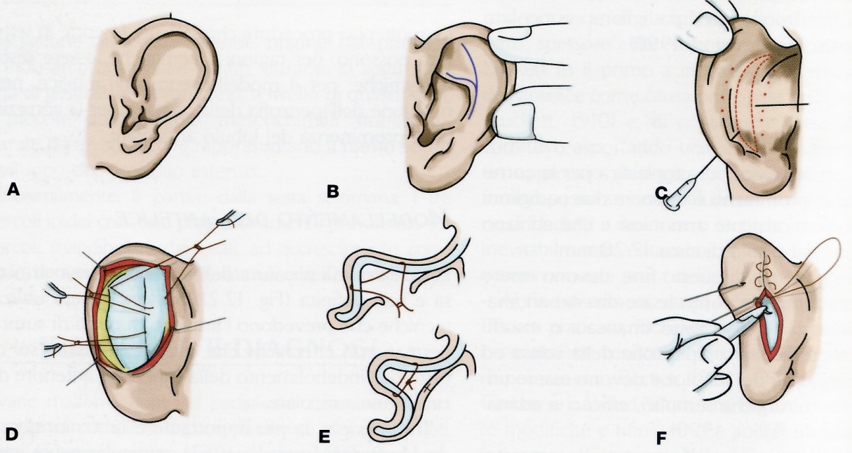 Otoplastica correzione orecchie prominenti