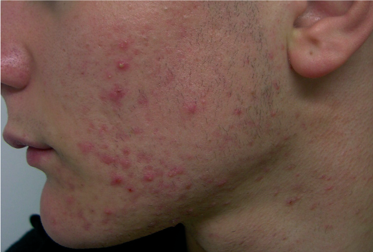 Radiofrequenza acne attiva risultato 1