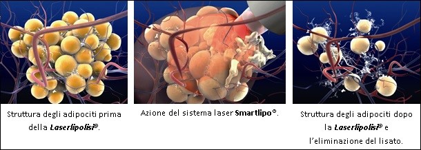 SmartLipo